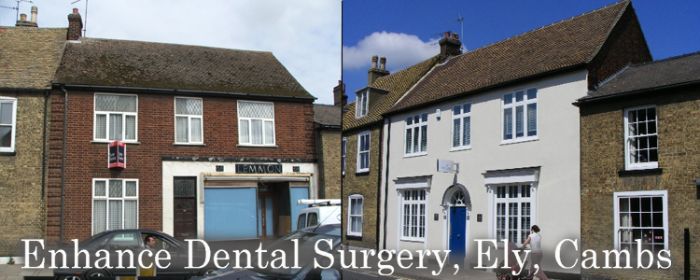 Dental Facade Ely